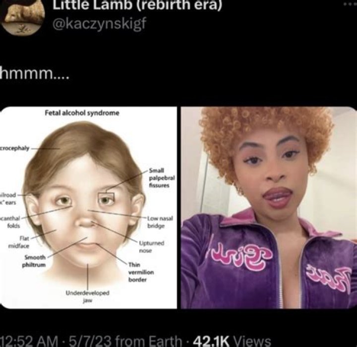 Does Ree Drummonds brother Mike have Downs syndrome? ·